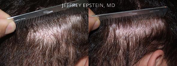 Reparative Before and after in Miami, FL, Paciente 40761