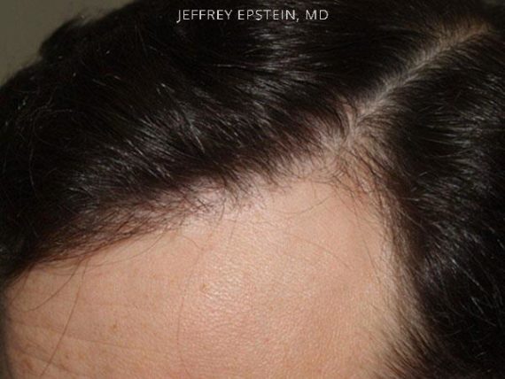 Reparative Hair Transplant Before and after in Miami, FL, Paciente 40764