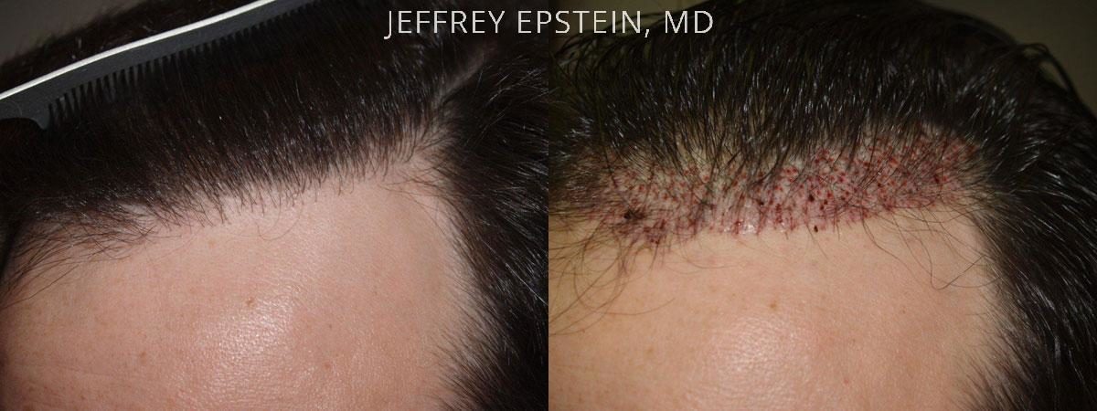 Reparative Before and after in Miami, FL, Paciente 40764