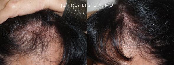 Reparative Hair Transplant Before and after in Miami, FL, Paciente 40787