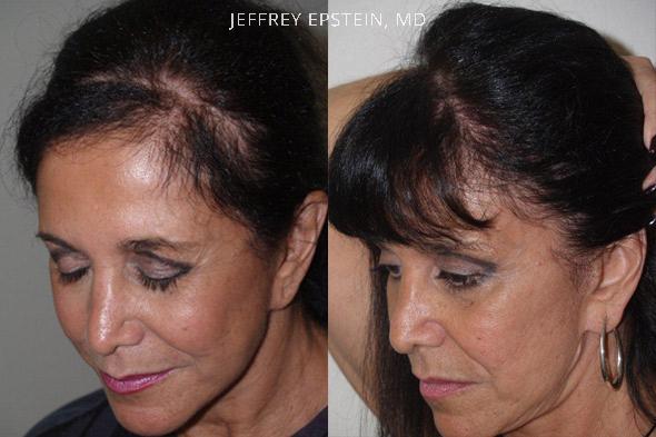 Reparative Hair Transplant Before and after in Miami, FL, Paciente 40787