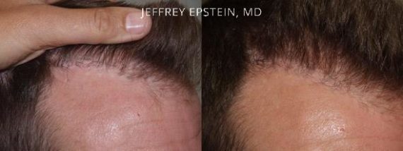Reparative Before and after in Miami, FL, Paciente 40792