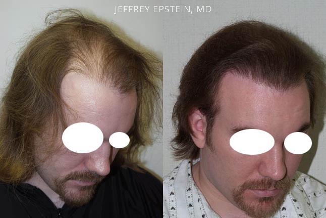 Reparative Hair Transplant photos | Miami, FL | Patient40797