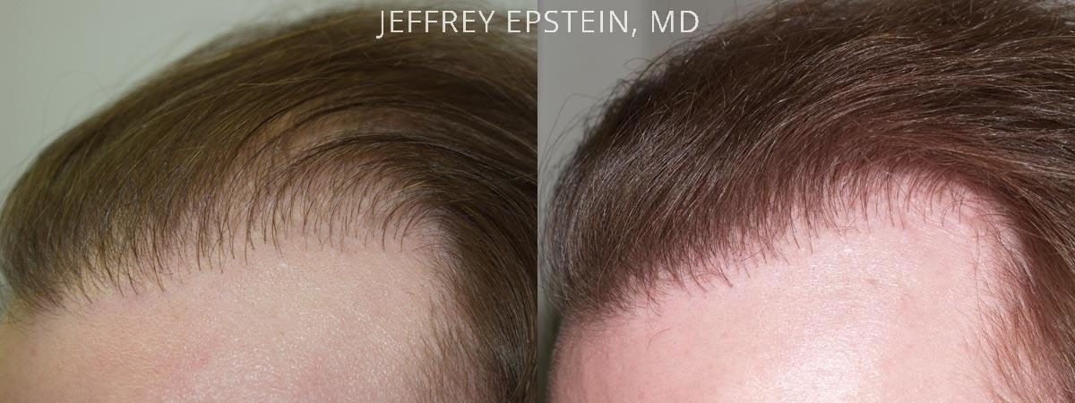Reparative Hair Transplant Before and after in Miami, FL, Paciente 40797