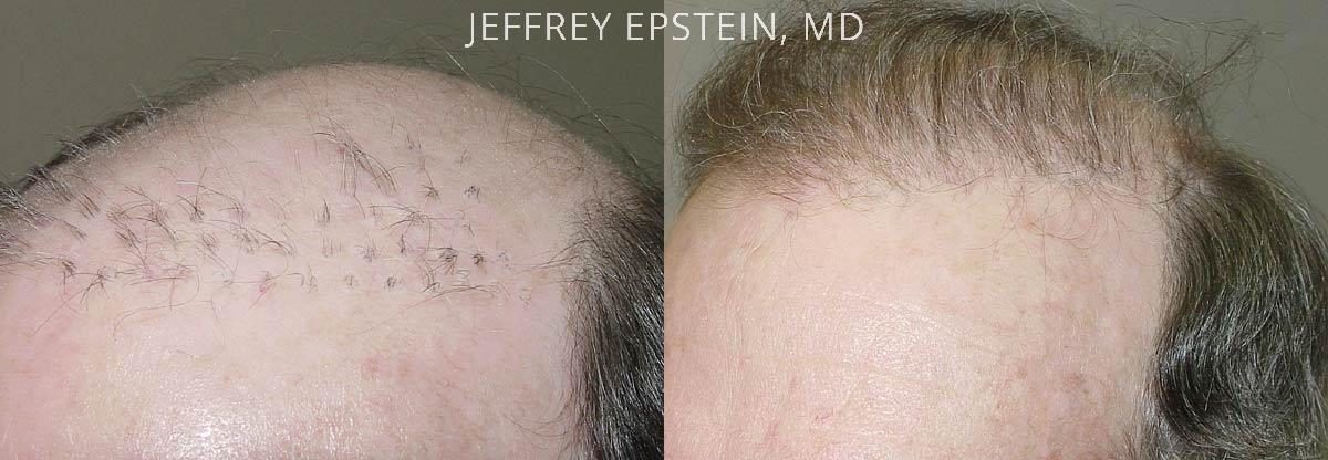 Reparative Hair Transplant Before and after in Miami, FL, Paciente 40804