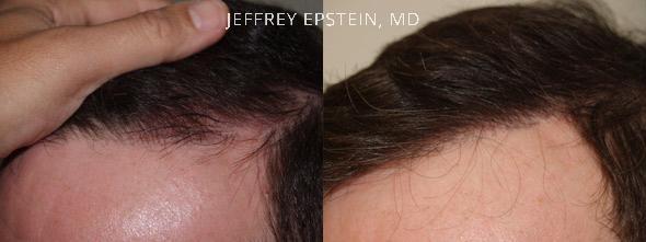 Reparative Hair Transplant Before and after in Miami, FL, Paciente 40812