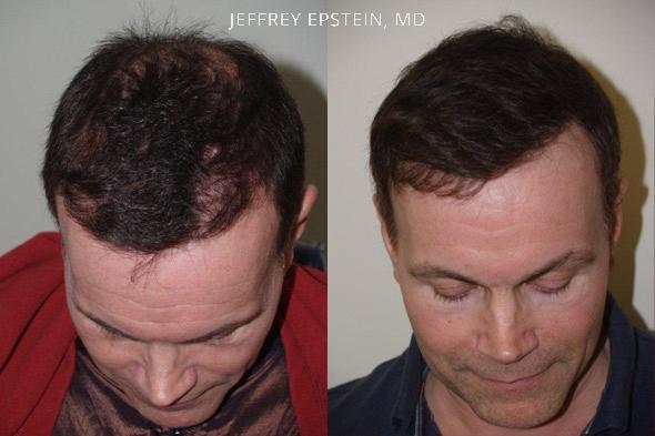 Reparative Hair Transplant Before and after in Miami, FL, Paciente 40812