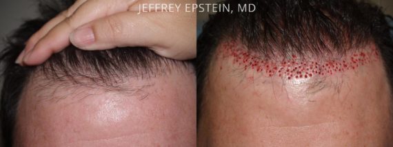 Reparative Before and after in Miami, FL, Paciente 40821