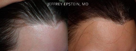 Reparative Hair Transplant Before and after in Miami, FL, Paciente 40828