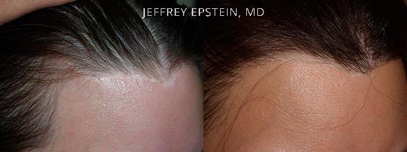 Reparative Hair Transplant Before and after in Miami, FL, Paciente 40828