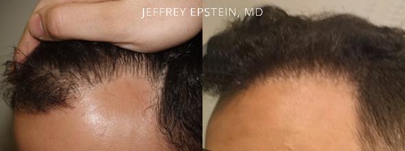 Reparative Before and after in Miami, FL, Paciente 40834