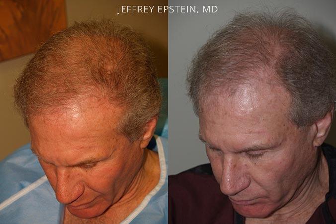 Reparative Hair Transplant Before and after in Miami, FL, Paciente 40839