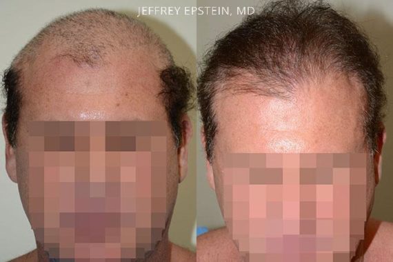 Reparative Before and after in Miami, FL, Paciente 40842