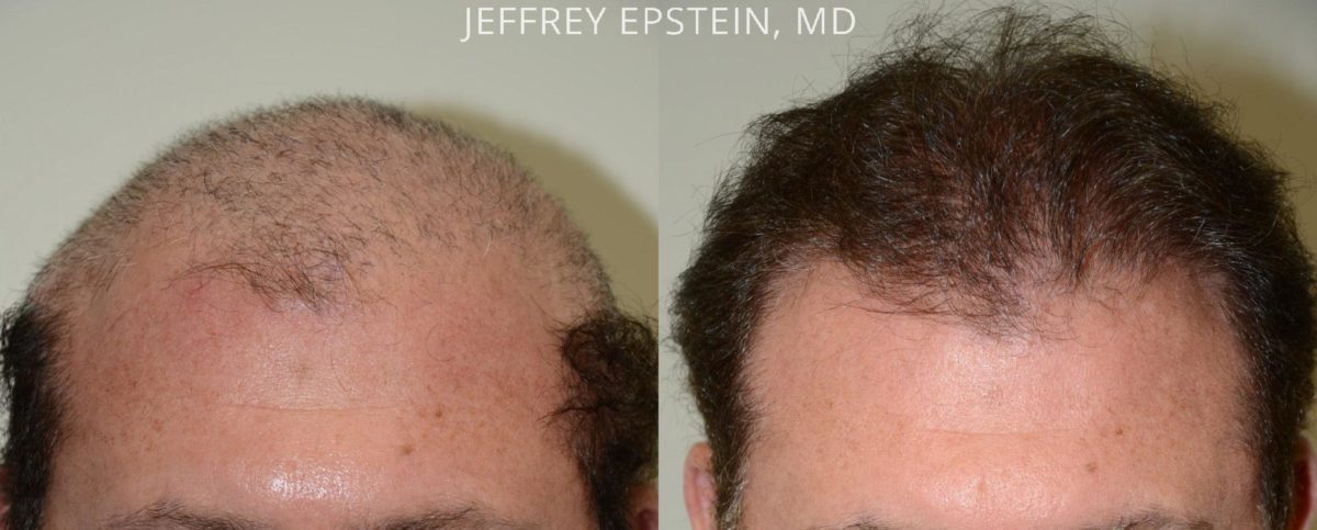 Reparative Before and after in Miami, FL, Paciente 40848
