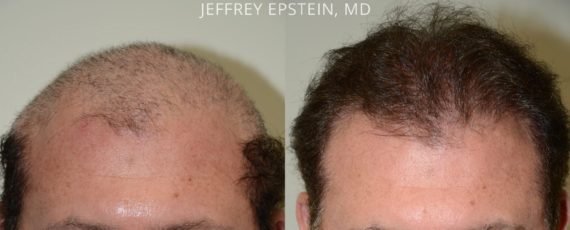 Reparative Hair Transplant Before and after in Miami, FL, Paciente 40848