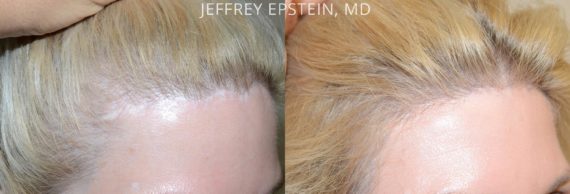 Reparative Before and after in Miami, FL, Paciente 40852