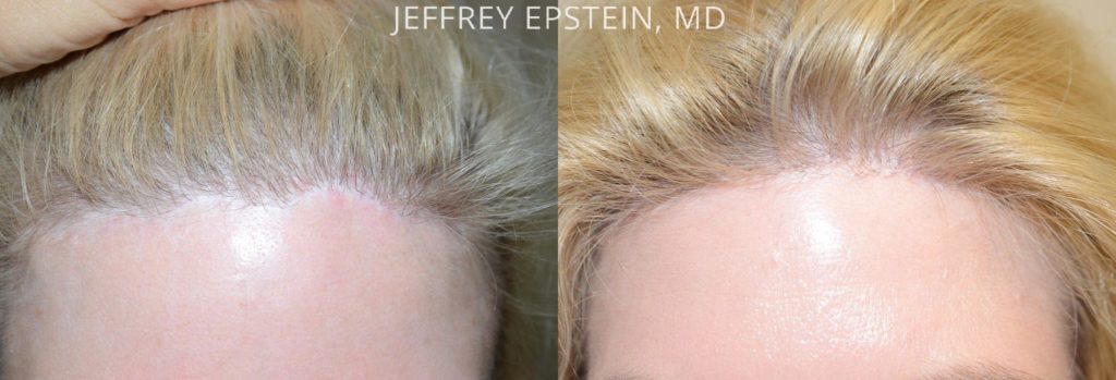 Las cicatrices previas en esta mujer de 42 años se pueden corregir, en este caso con un procedimientode 1100 injertos para crear una línea de pelo más suave y natural que oculta la cicatriz abrupta.