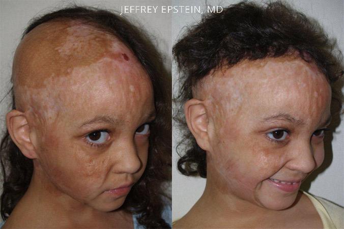 Special Cases Before and after in Miami, FL, Paciente 40859