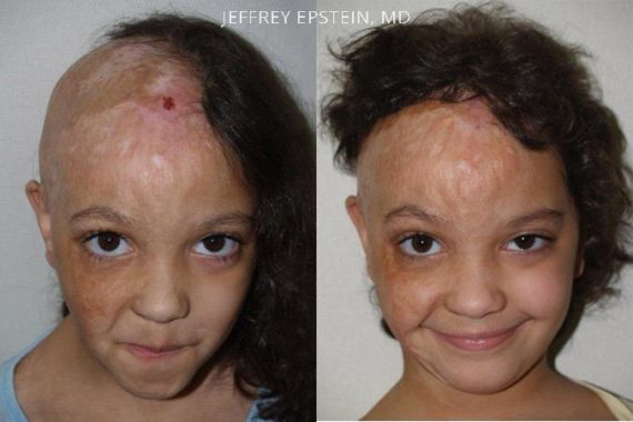 Special Cases Before and after in Miami, FL, Paciente 40859