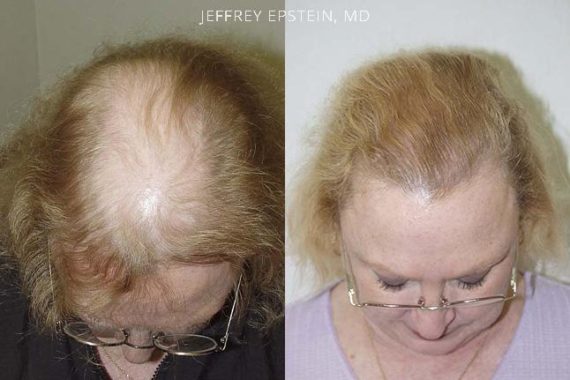 Casos Especiales Before and after in Miami, FL, Paciente 98250