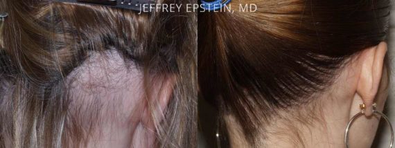 Special Cases Before and after in Miami, FL, Paciente 40897
