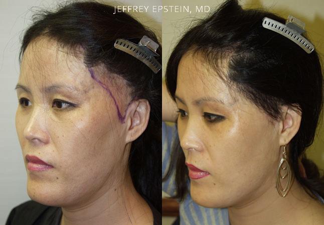 Special Cases Before and after in Miami, FL, Paciente 40902