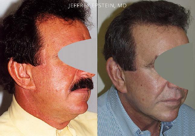 Special Cases Before and after in Miami, FL, Paciente 40915