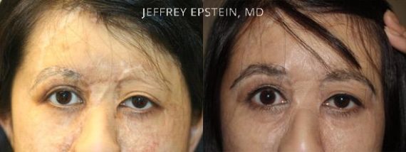Casos Especiales Before and after in Miami, FL, Paciente 98024