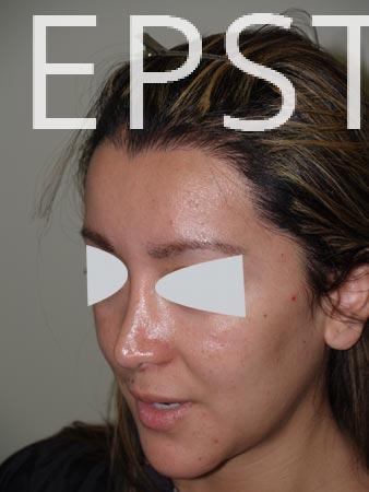 Special Cases Before and after in Miami, FL, Paciente 40933