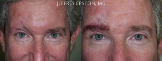Casos Especiales Before and after in Miami, FL, Paciente 97875