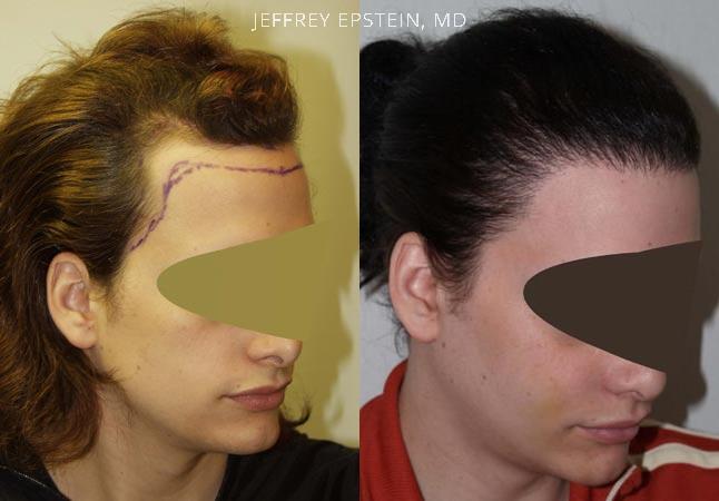 Special Cases Before and after in Miami, FL, Paciente 40959