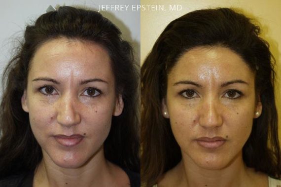 Special Cases Before and after in Miami, FL, Paciente 40972
