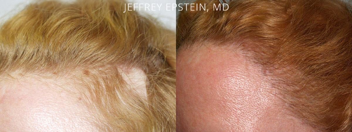 Special Cases Before and after in Miami, FL, Paciente 40984