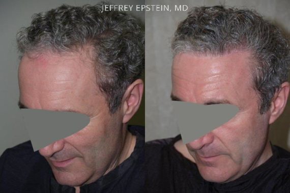 Casos Especiales Before and after in Miami, FL, Paciente 97509