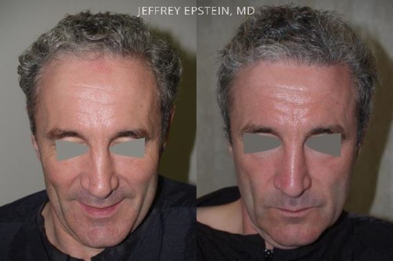 Casos Especiales Before and after in Miami, FL, Paciente 97509