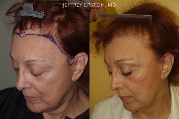 Casos Especiales Before and after in Miami, FL, Paciente 97392