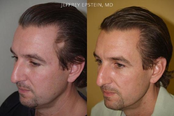 Casos Especiales Before and after in Miami, FL, Paciente 97363