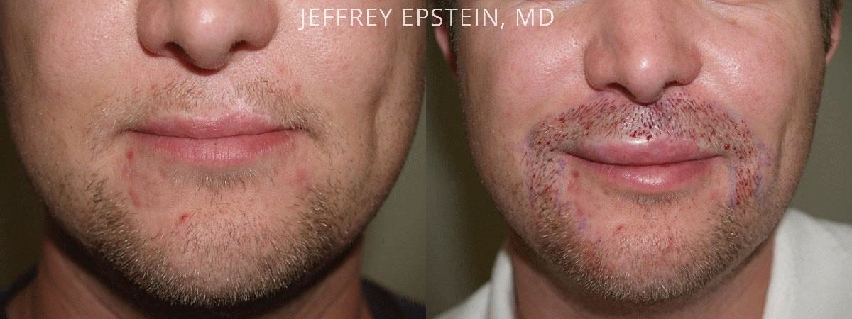 Special Cases Before and after in Miami, FL, Paciente 41036