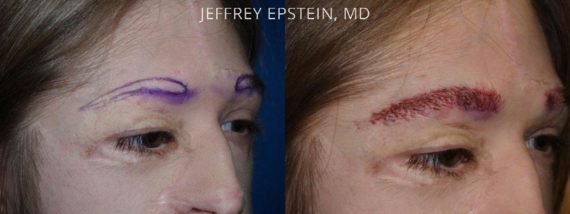 Casos Especiales Before and after in Miami, FL, Paciente 97293
