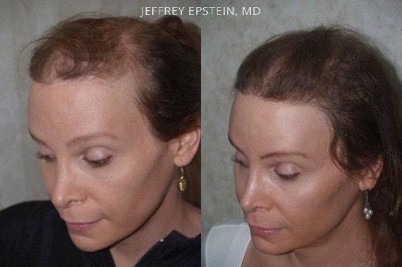 Special Cases Before and after in Miami, FL, Paciente 41047