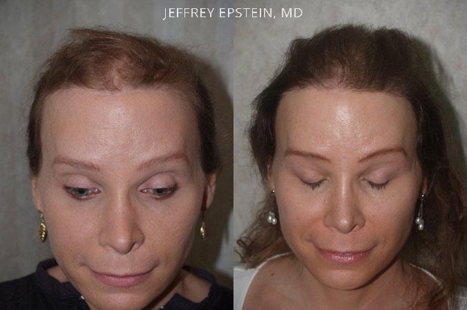 Special Cases Before and after in Miami, FL, Paciente 41047