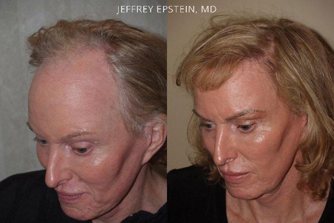 Special Cases Before and after in Miami, FL, Paciente 41053
