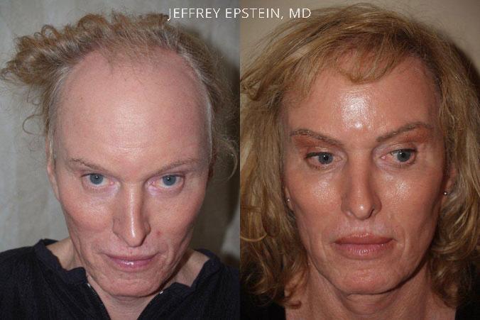 Special Cases Before and after in Miami, FL, Paciente 41053