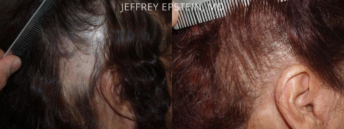 Special Cases Before and after in Miami, FL, Paciente 41062