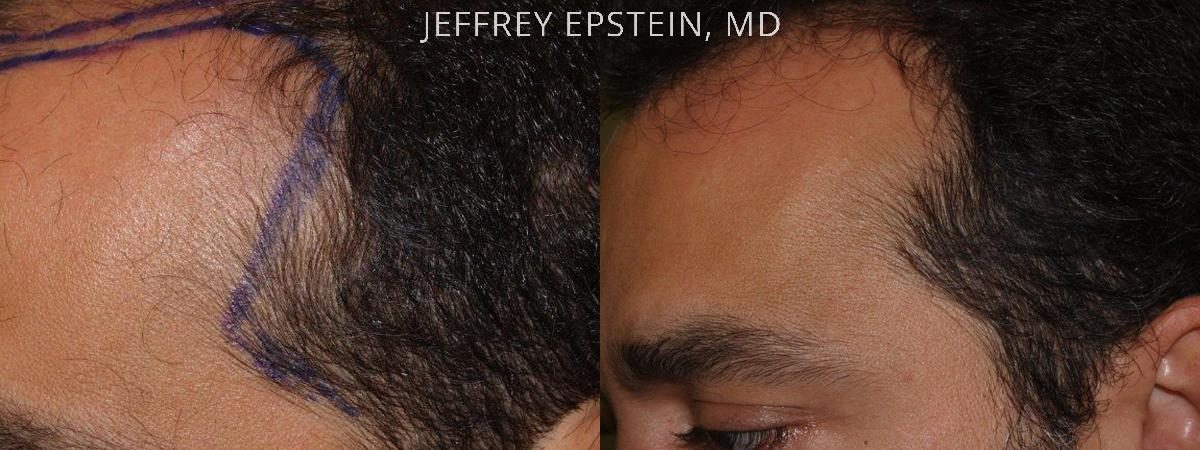 Special Cases Before and after in Miami, FL, Paciente 41068