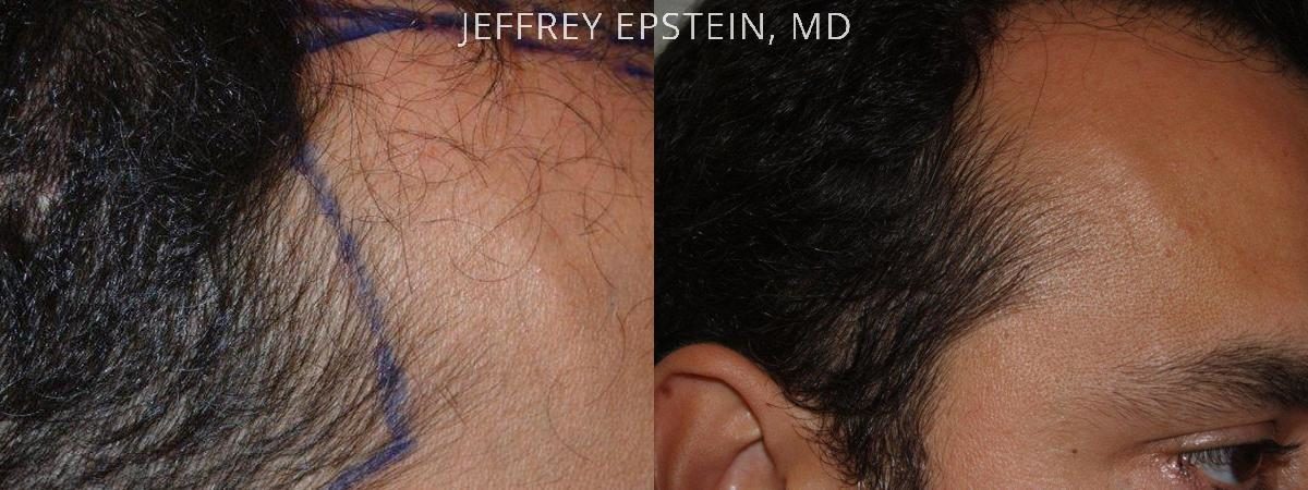 Special Cases Before and after in Miami, FL, Paciente 41068