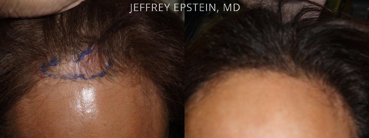 Special Cases Before and after in Miami, FL, Paciente 41078