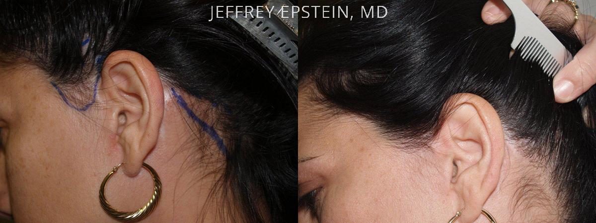 Special Cases Before and after in Miami, FL, Paciente 41083