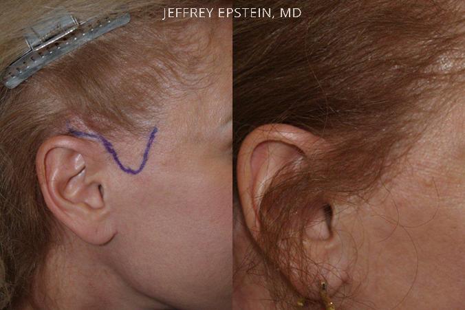 Special Cases Before and after in Miami, FL, Paciente 41109