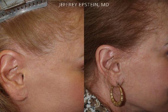 Casos Especiales Before and after in Miami, FL, Paciente 96891